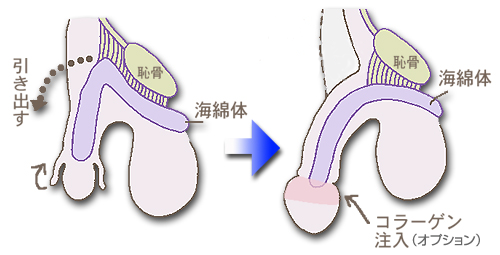 長茎治療（ペニスを長く）｜札幌中央クリニック