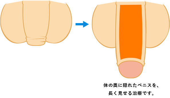 短小包茎とは！短小は何センチから？日本人の平均サイズや治療法 - アトムクリニック - atom-clinic