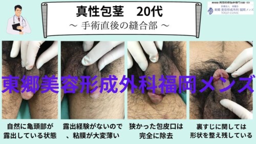 包茎手術体験談 ～世界一の遅漏が語る、20年越しの後悔～ - TENGAヘルスケア プロダクトサイト