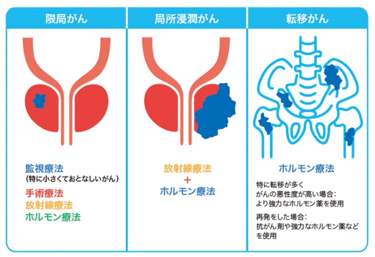 泌尿器科｜前立腺がんの薬物療法｜順天堂大学医学部附属順天堂医院