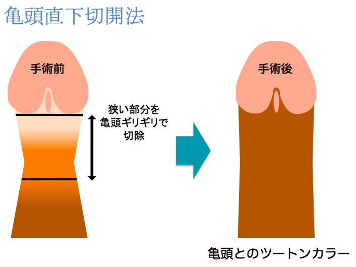 包茎手術 - 台北の謝泌尿器科クリニック