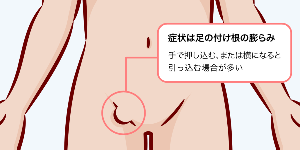 鼠径部痛症候群（グロインペイン）について - たまプラーザの鍼灸なら改善率93.5％を誇る東洋はり灸院 たまプラーザ院