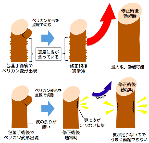 包茎手術の跡、傷跡は残る？｜包茎手術・治療なら上野クリニック