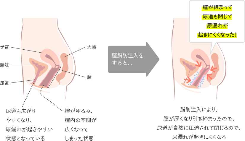 セントラルレディースクリニック,骨盤底障害,性器脱,排尿障害