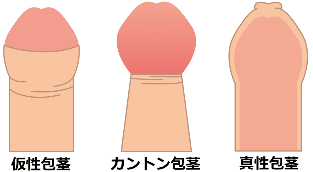 包茎手術 | 性感帯と自然な仕上がりを重要視した包茎手術は沖縄のひろ耳鼻科・皮膚科・形成外科