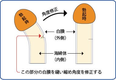 シリコンボール｜薄毛・AGA治療・ED治療薬処方｜美容外科形成外科 川崎中央クリニック・メンズサイト