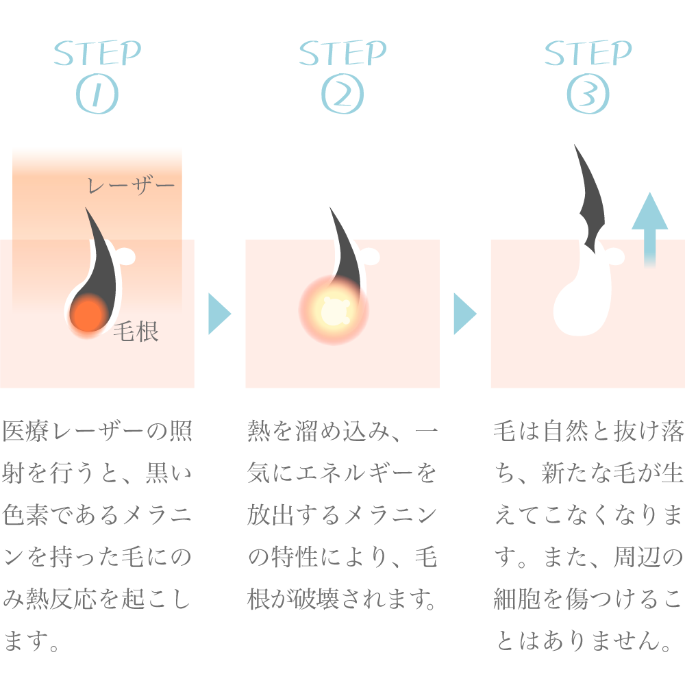 医療レーザーVIO脱毛はどれくらい痛い？サロン脱毛との差や痛み軽減方法を紹介｜脱毛の悩みに答えるwebマガジン