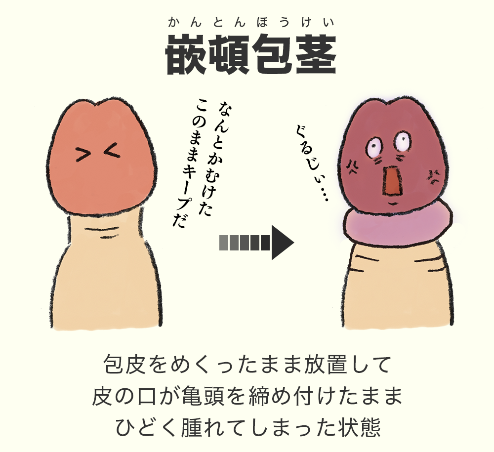 泌尿器科の専門医が徹底解説】真性包茎の手術で知っておくべき８つの知識