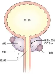 悩ましい「残尿」に秘策はあるか？ | ライフリー