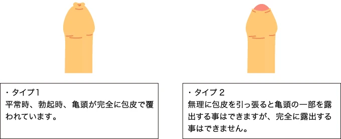 亀頭が痛い、敏感すぎるのは包茎が原因？包茎治療や自力での改善方法を紹介 | メンズライフクリニック【公式】