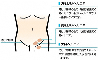 大動脈瘤 | 症状・部位から診療科を探す