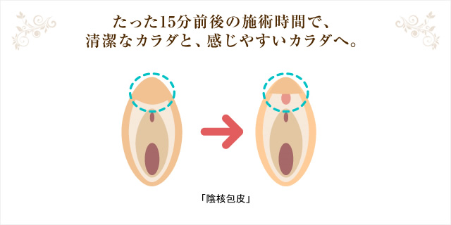 女性の包茎】クリトリス包茎とは？原因や影響を徹底解説！│SELECT CLINIC TIPS