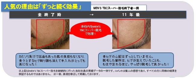 メンズTBCのヒゲ脱毛体験レポート｜実際の痛みや効果＆料金を公開 - カスタムライフmedical