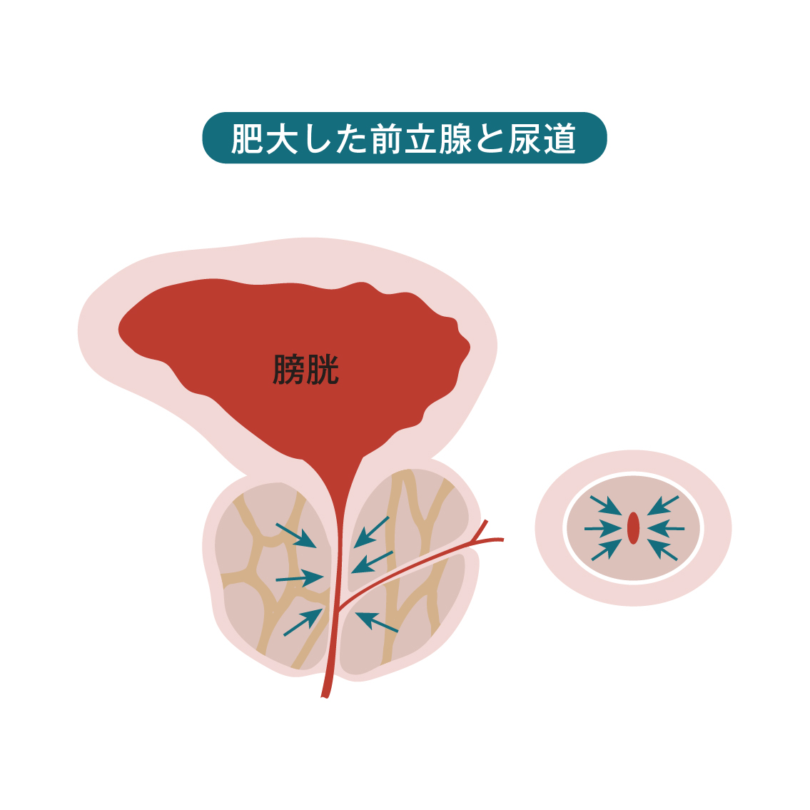 慢性前立腺炎を根本から改善する治し方「衝撃波治療」について | 大阪梅田紳士クリニック