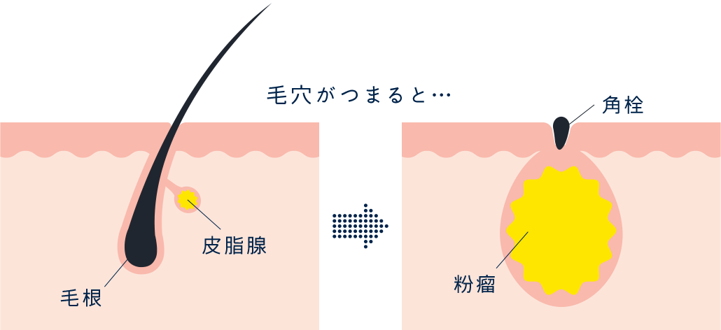 粉瘤｜近鉄生駒駅【奈良】の形成外科・美容皮膚科｜なかにし形成外科クリニック