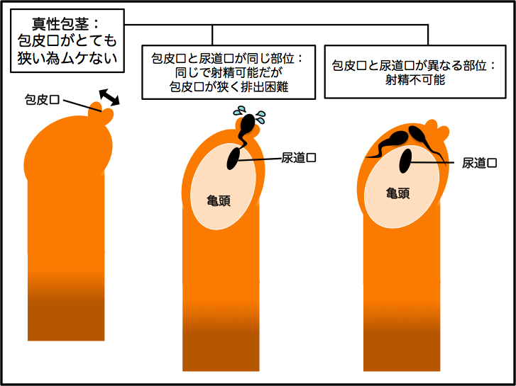 体験談 – メンズ形成外科