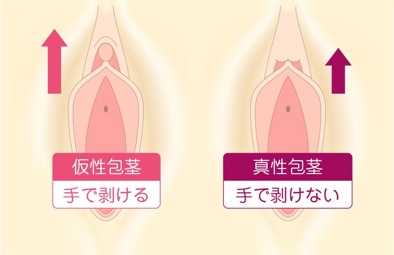 痛み – 中学生の時に実施した包茎手術と術後の体験エピソード