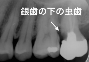 その銀歯って安全？ ｜ ノンメタル治療なら寝屋川・吹田｜ひしだ歯科クリニック｜矯正歯科・インプラント・マウスピース矯正