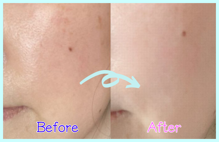 100円で全身脱毛＋両ワキ・Vライン2年通い放題！ミュゼ7月キャンペーン情報