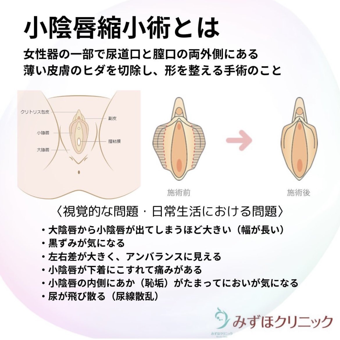 小陰唇縮小術｜びらびらを切除する婦人科形成｜新宿駅前婦人科クリニック【東京】