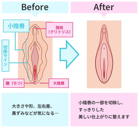 女性器形成（婦人科形成） - 渋谷の美容外科・美容整形クリニック | ドクターミナガワ渋谷整形