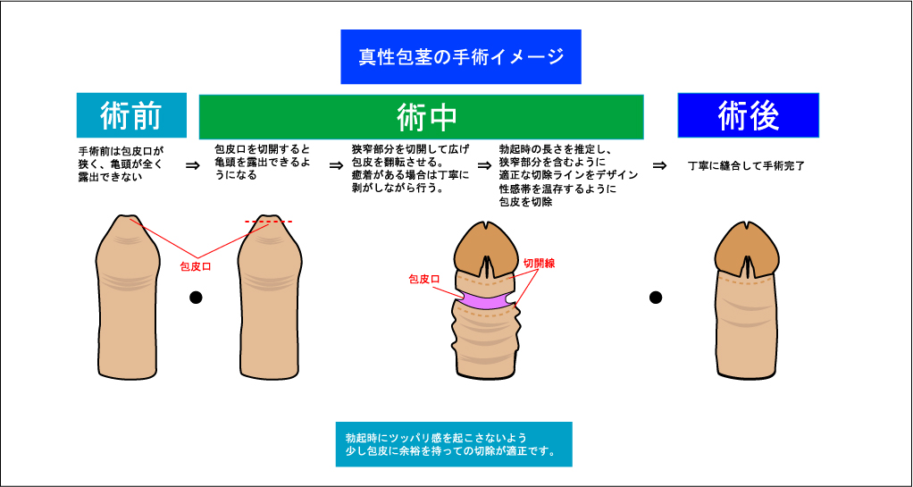 ちんこの皮が多い…」9割の男性が知らない皮が多いデメリットとは？ | 【フェアクリニック】包茎・薄毛・男の悩み相談所