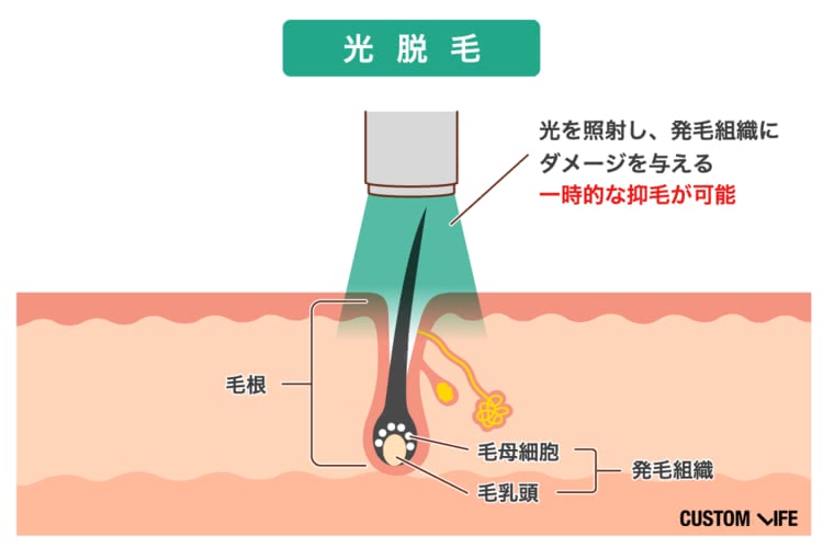 ヒゲ剃り楽々脱毛コース | メンズTBC