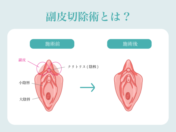 クリトリス包茎 | アールビューティークリニック 銀座・名古屋・大阪｜美容整形・美容外科・美容皮膚科