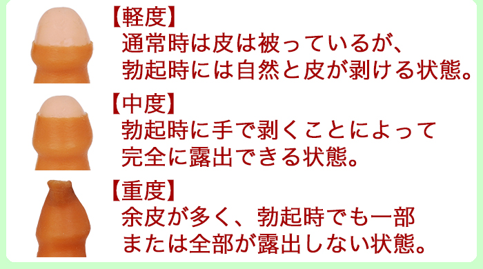 楽天市場】あす楽 真性包茎矯正具 無段階調整付 ムケル君【返金保証付】 男性器