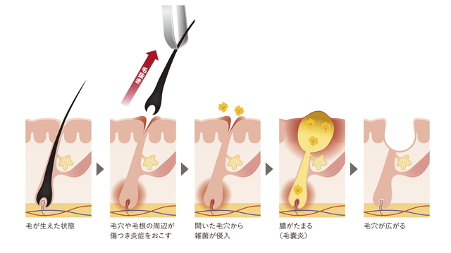 医師監修】深い埋没毛の取り出し方は？ピンセットやピーリングで対処できる？ | Midashinami 身だしなみ