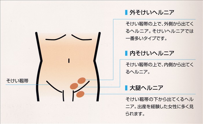 写真・画像】【消化器外科編]】鼠径ヘルニア 春の健康特集2018 |