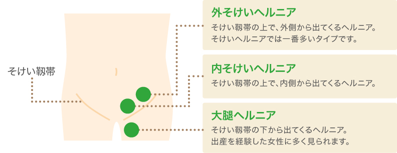 疾患啓発資材設置にご協力をお願いします - そけいヘルニアノート