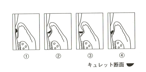 腟自体曲がってるねって言われました。 真っ直ぐにする事は可能ですか？ 挿入角度が難しいと言われました。 | Peing