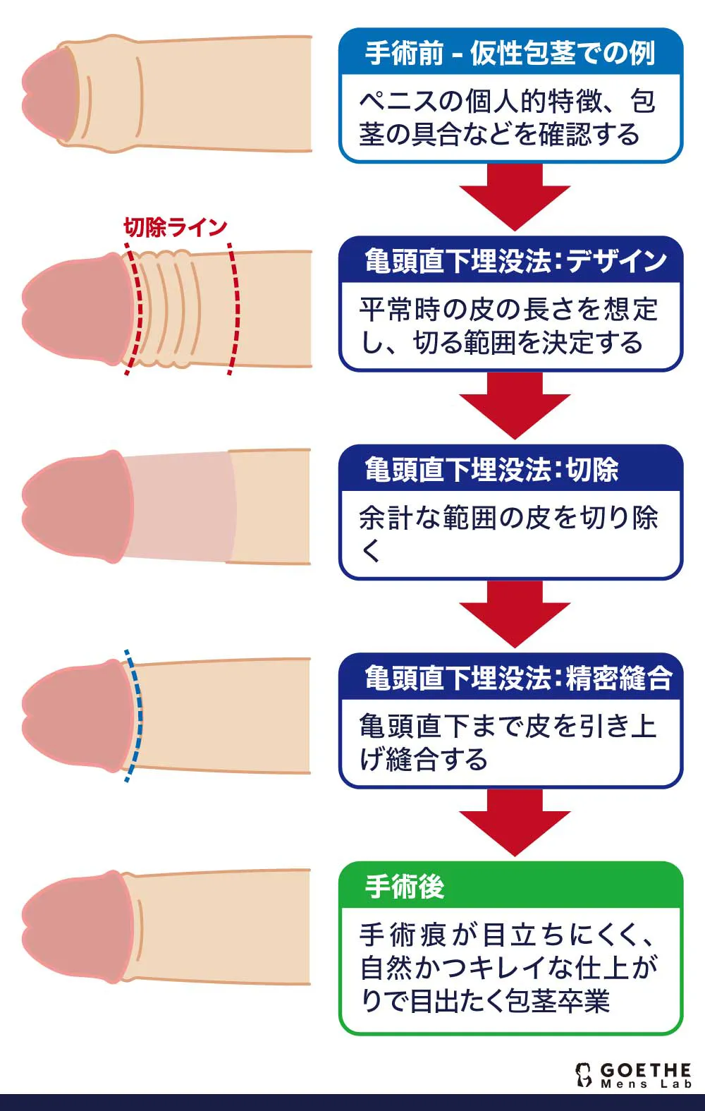 仮性包茎とはどんな包茎？デメリットや起こりうるリスクについて徹底解説 - まちかど薬局情報館