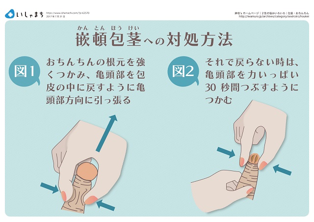 子どもの包茎」むきむき体操（包皮翻転指導）のすすめ – いしゃまち