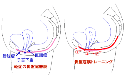 骨盤底医療部門（骨盤臓器脱・尿失禁など） | 女性医療センター