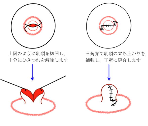 陥没乳頭（陥没乳首）の手術｜日本医科大学武蔵小杉病院