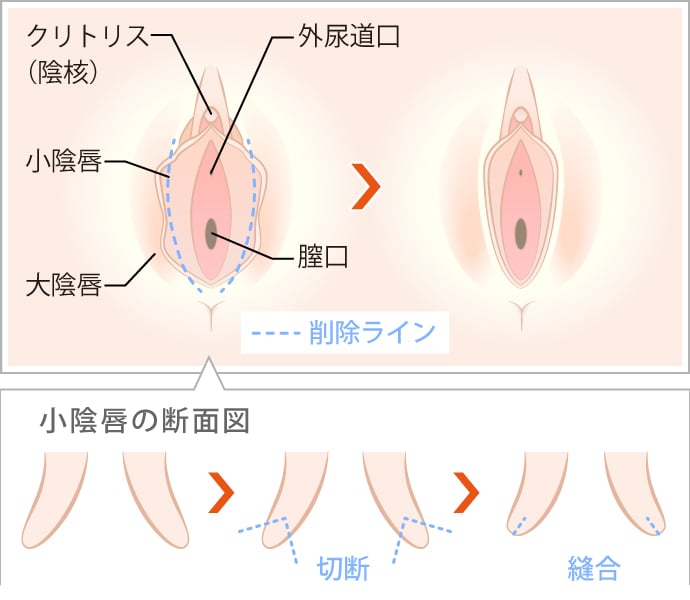 図解画像】クリトリスの皮を剥くべきか？剥かないべきか？正しい皮の剥き方とは？ - sexprogress.com