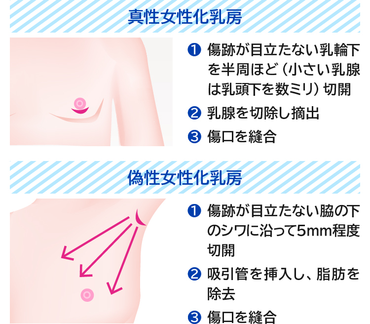 乳首を切除した」女性の人生。胸に突起物がついているのが「どうしても嫌だな」と感じた（週刊SPA!） - Yahoo!ニュース