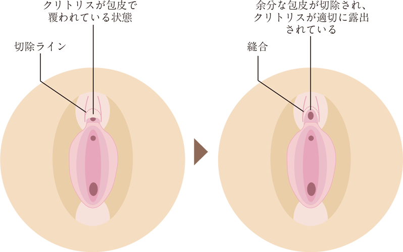 婦人科形成（女性器形成）｜あゆ皮フ科クリニック｜高槻市の一般皮膚科・小児皮膚科・皮膚外科・美容皮膚科・美容外科