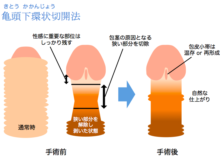 仮性包茎と真性包茎のコンドームの付け方！【医師監修】 - 夜の保健室