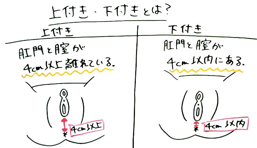 盛りマン（土手高）とは？原因やメリット・デメリットなどについて紹介！｜風じゃマガジン