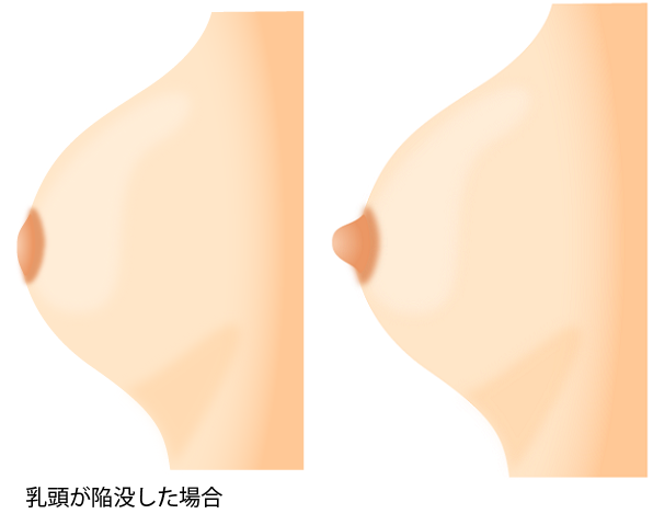 勃ち上がれ陥没乳首】勃起の瞬間あつめました - DLチャンネル みんなで作る二次元情報サイト！