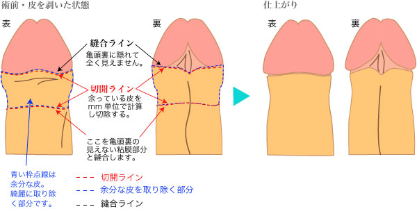 包茎手術について 静岡 橋本クリニック | 静岡美容外科