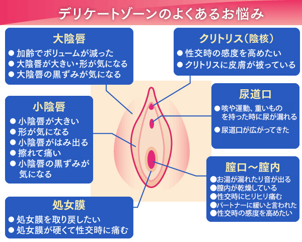 クリトリス包茎 | 婦人科のお悩み |