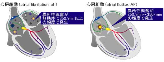 心房細動と心房粗動