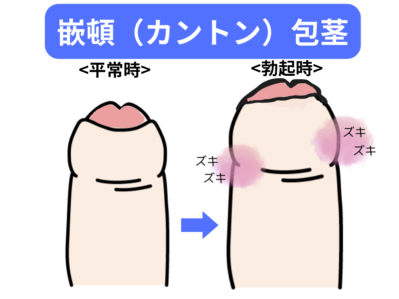 泌尿器科の専門医が徹底解説】真性包茎の手術で知っておくべき８つの知識