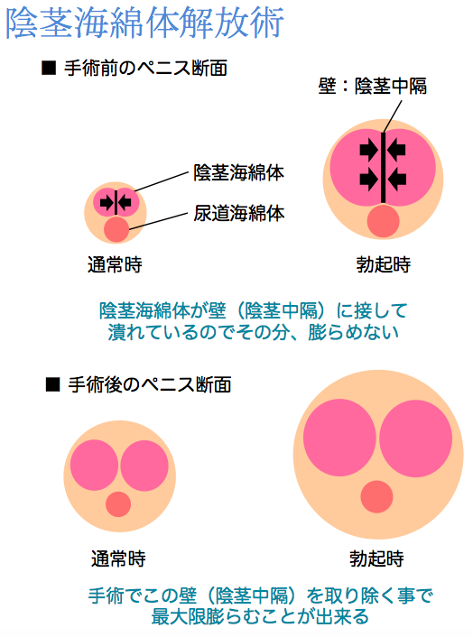 ペニス増大・陰茎増大｜MSクリニック