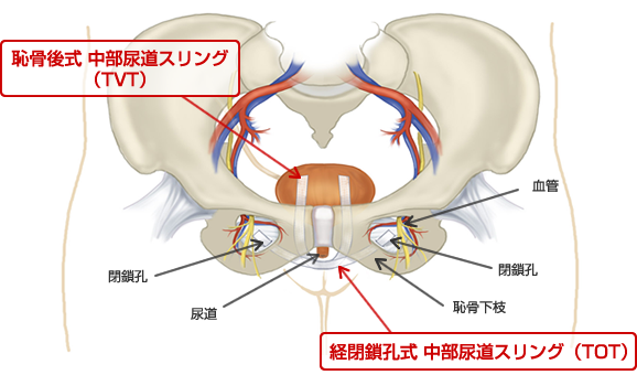 骨盤臓器脱 - 子宮脱治療、膀胱脱治療や直腸脱治療について専門医が説明します|Ｕｒｏｇｙｎｅネット