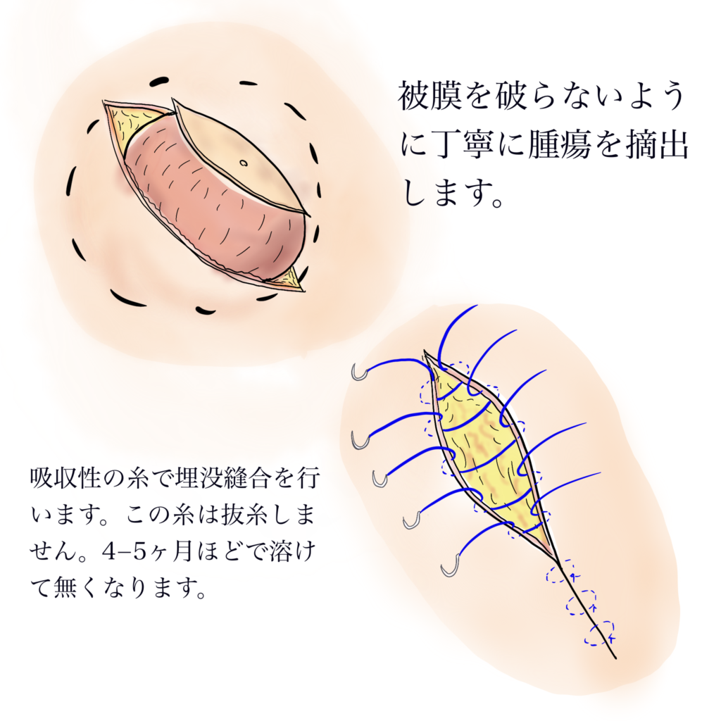 粉瘤LP | 千葉北佐々木クリニック